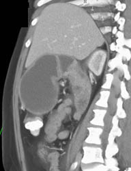 Antral Carcinoma - CTisus CT Scan