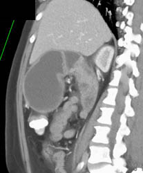 Antral Carcinoma - CTisus CT Scan