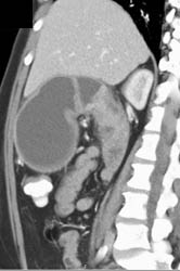 Antral Carcinoma - CTisus CT Scan