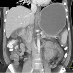 Antral Carcinoma - CTisus CT Scan