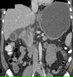 Antral Carcinoma - CTisus CT Scan