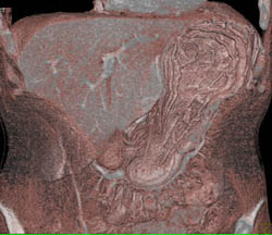 3D of Gastric Cancer - CTisus CT Scan