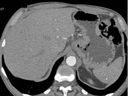 Gastric Cancer at Gastroesophageal (GE) Junction With Celiac Nodes - CTisus CT Scan