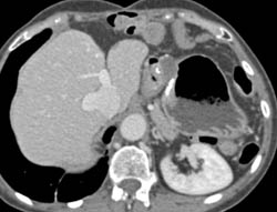 GIST Tumor - CTisus CT Scan