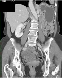 Gastric Cancer - CTisus CT Scan