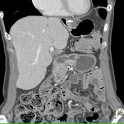 Gastric Cancer - CTisus CT Scan