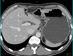 Gastric Cancer - CTisus CT Scan