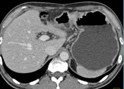 Gastric Cancer - CTisus CT Scan