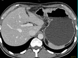 Gastric Cancer - CTisus CT Scan