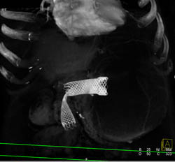 Stent in Gastric Antrum With Tumor Infiltration - CTisus CT Scan