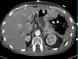 Perforated Gastric Tumor- Gist With Stent - CTisus CT Scan