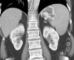 Gastric Varices - CTisus CT Scan