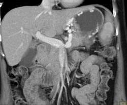 Gastric Varices - CTisus CT Scan