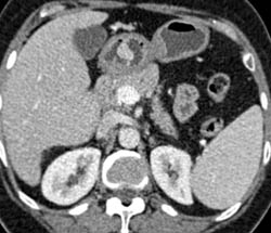 Antral Polyp That Enhances Was Inflammatory - CTisus CT Scan