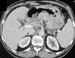 Bulky Gastric Cancer With Nodes - CTisus CT Scan