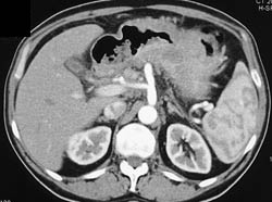 Linitis Plastica - CTisus CT Scan