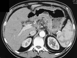 Linitis Plastica - CTisus CT Scan