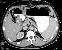 Antral Carcinoma - CTisus CT Scan