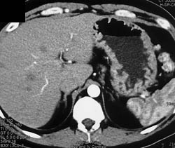 Gastritis - CTisus CT Scan