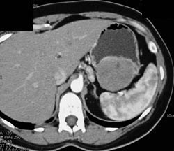 GIST Tumor With Ulceration - CTisus CT Scan