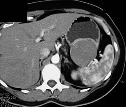 GIST Tumor With Ulceration - CTisus CT Scan