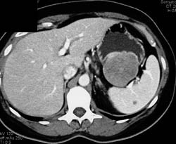 GIST Tumor With Ulceration - CTisus CT Scan