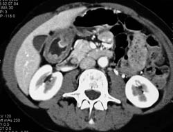 Antral Carcinoma - CTisus CT Scan