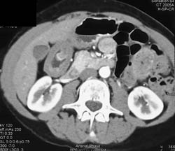 Antral Carcinoma - CTisus CT Scan