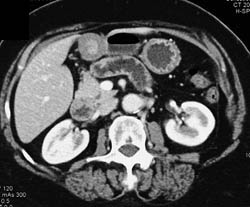 Normal Gastric Antrum Simulates A Mass - CTisus CT Scan