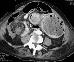 Canada Cronkite Stomach With Multiple Polyps - CTisus CT Scan