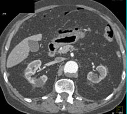 Antral Ulcer With Perforation - CTisus CT Scan