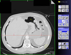 Gastric Cancer With Endoluminal View - CTisus CT Scan