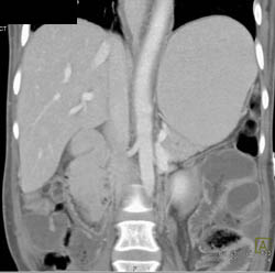 Tumor Duodenum Obstructs the Stomach - CTisus CT Scan