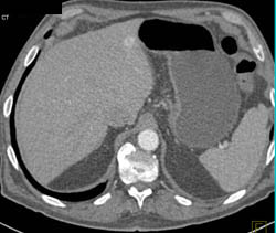 Vascular Polyp in Antrum C/w Cancer Bx Was Inflammatory - CTisus CT Scan