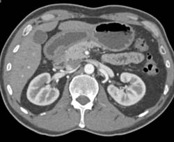 Antral Infiltration With Linitis Plastica - CTisus CT Scan