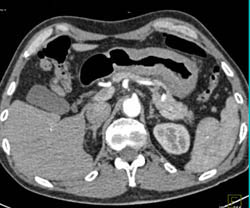 Linitis Plastica - CTisus CT Scan