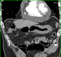 Linitis Plastica - CTisus CT Scan