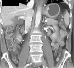 Linitis Plastica - CTisus CT Scan