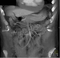 Linitis Plastica - CTisus CT Scan