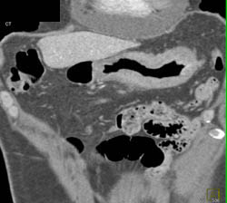 Linitis Plastica - CTisus CT Scan