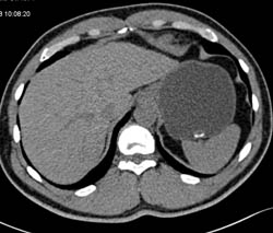 Pill in Stomach Simulates A Mass - CTisus CT Scan