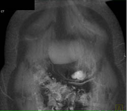 Incidental GIST Tumor - CTisus CT Scan