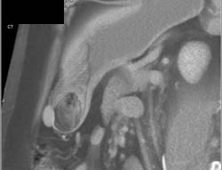 GIST Tumor - CTisus CT Scan