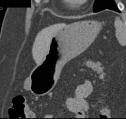 GIST Tumor - CTisus CT Scan