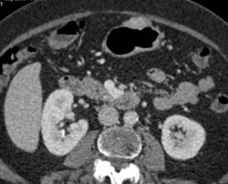 GIST Tumor - CTisus CT Scan