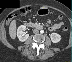 GIST Tumor - CTisus CT Scan