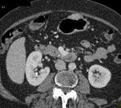 GIST Tumor - CTisus CT Scan