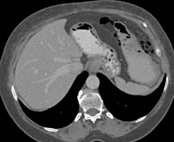 Gastric Emphysema With Perforation - CTisus CT Scan