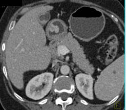 Benign Gastric Polyp - CTisus CT Scan