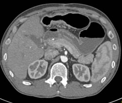 Linitis Plastica - CTisus CT Scan